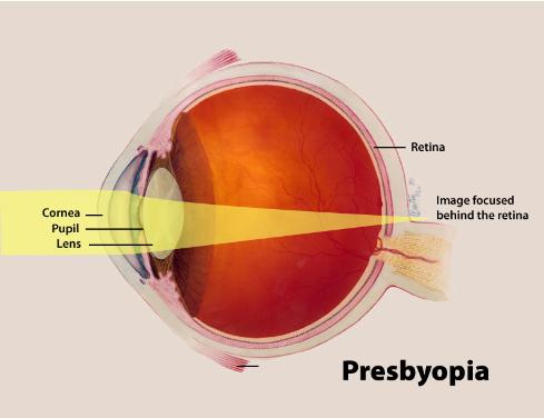 presbyopia